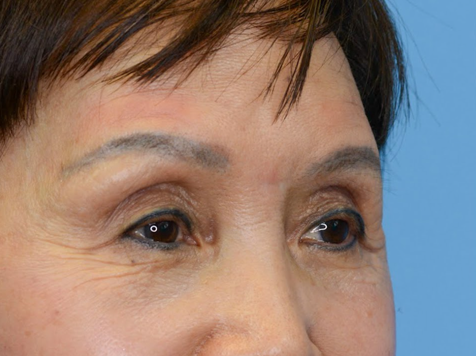 Patient's face before a Philadelphia brow lift