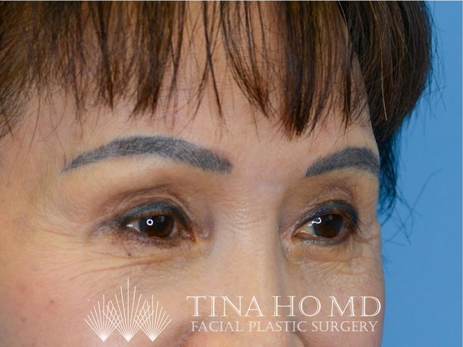Patient's face after a Philadelphia brow lift