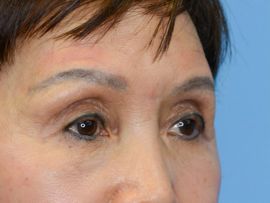 Patient's face before a Philadelphia brow lift