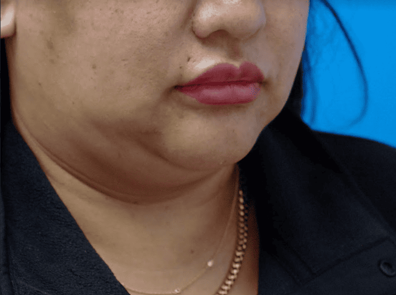 Patient's side profile before chin augmentation to achieve facial symmetry