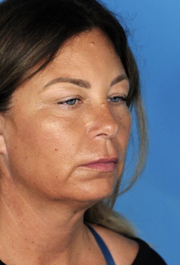 Patient's profile before chin augmentation to enhance lower facial aesthetics