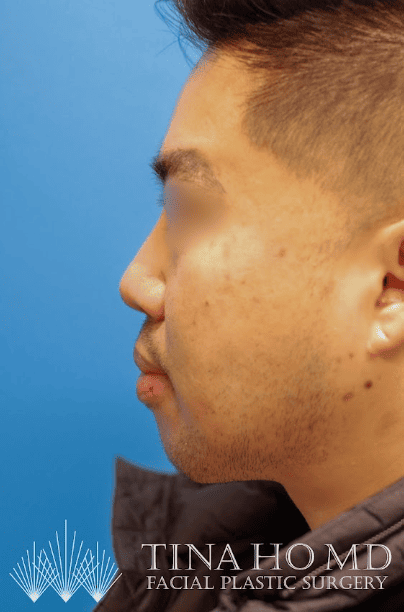 Refined lower face and neck after submental liposuction and chin augmentation treatment