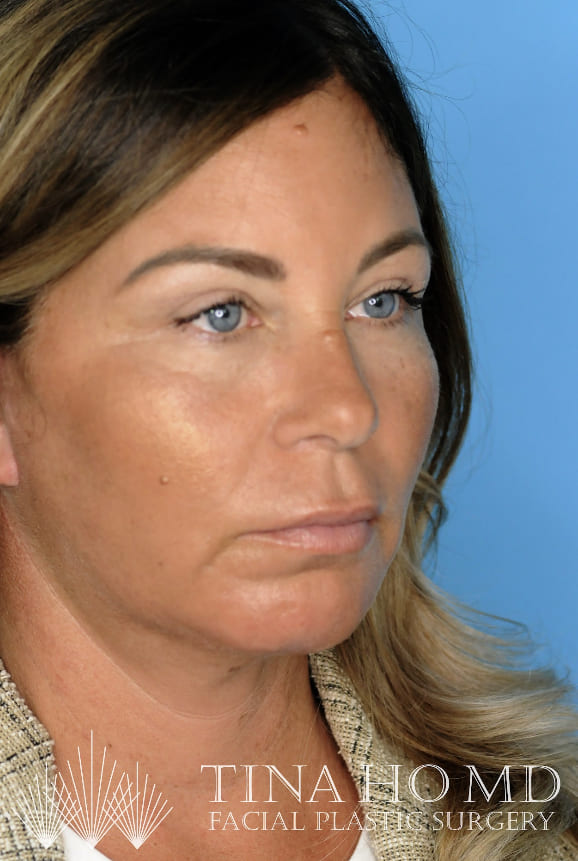 Patient's profile after chin augmentation shows enhanced lower facial aesthetics