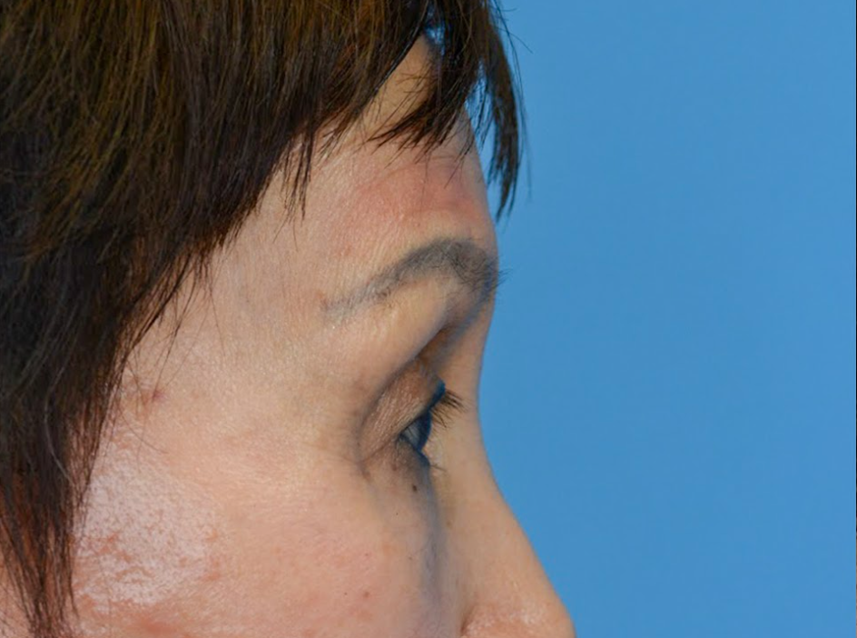 Patient's face before a Philadelphia brow lift