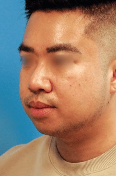 Man's chin and neck area before submental liposuction and chin augmentation procedure