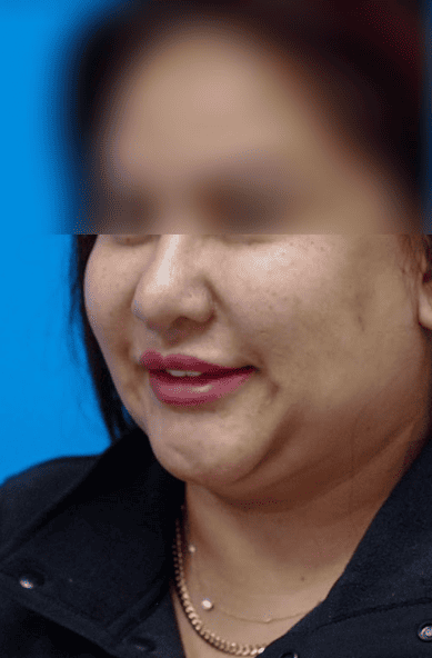 Patient's three-quarter profile before chin augmentation for a stronger profile