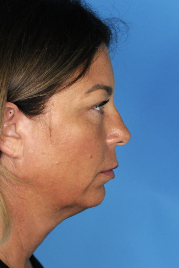 Patient's three-quarter view before chin augmentation to refine jawline