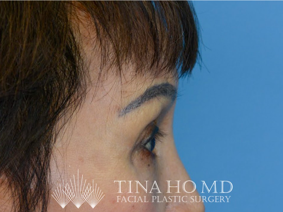 Patient's face after a Philadelphia brow lift