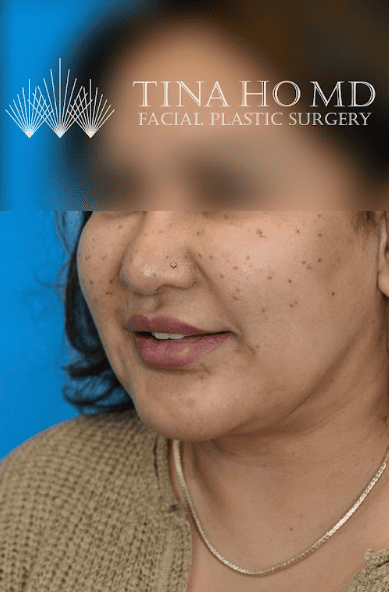 Patient's three-quarter profile after chin augmentation shows stronger profile
