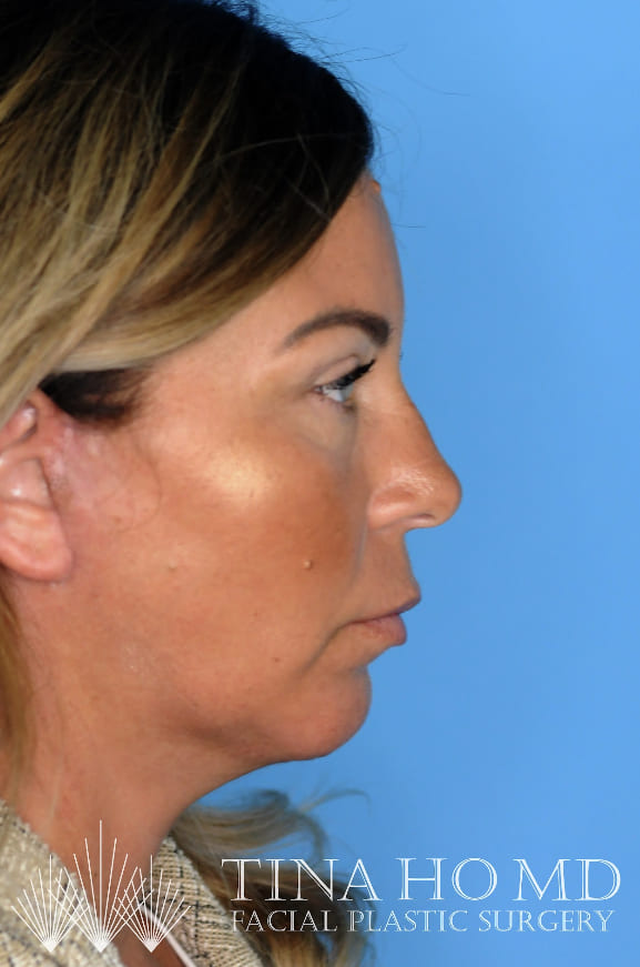 Patient's three-quarter view after chin augmentation refines jawline