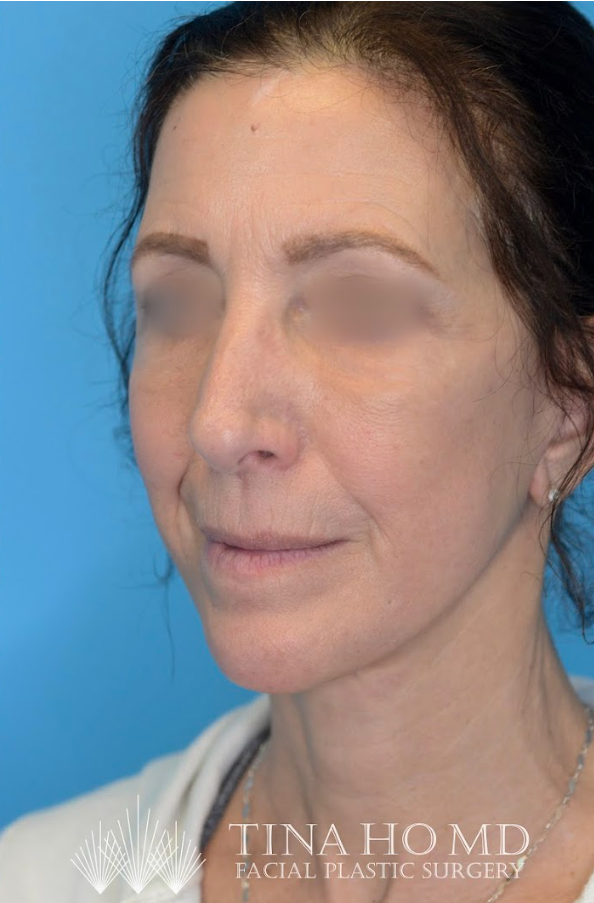 ML oblique after