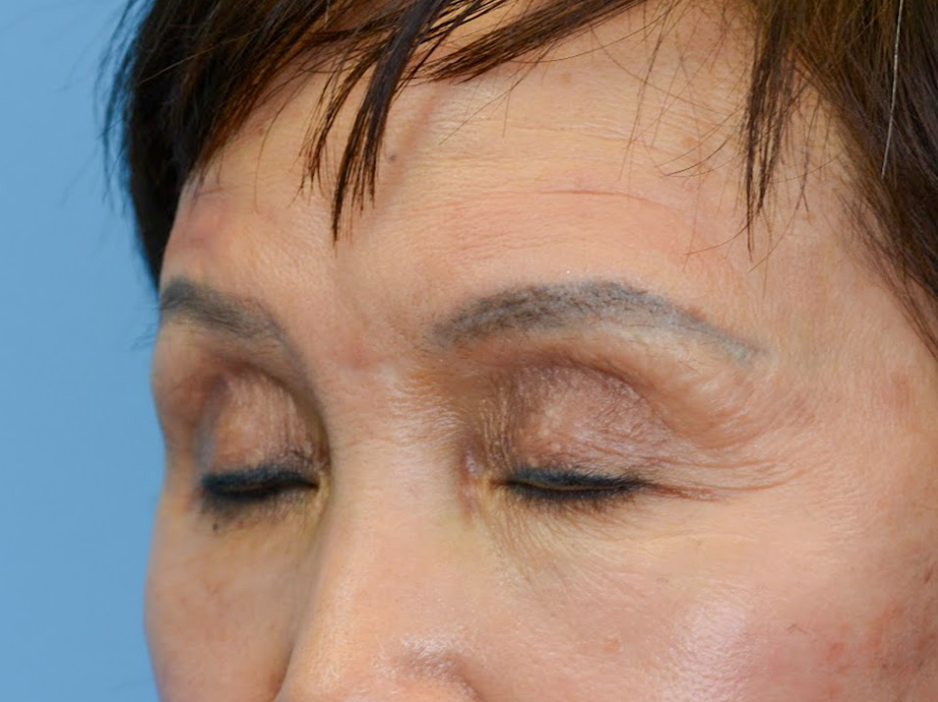 Patient's face before a Philadelphia brow lift
