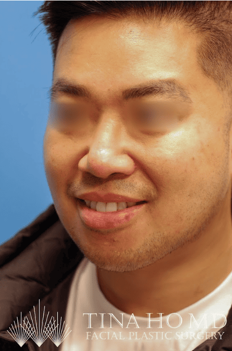 Patient's slimmer chin and neck after submental liposuction and chin augmentation treatment