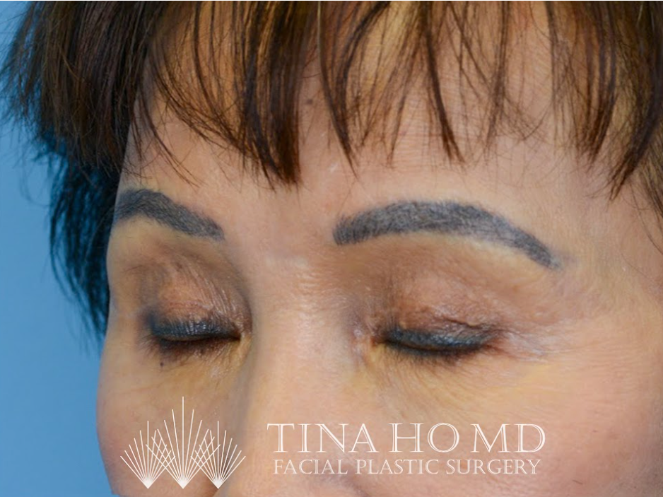 Patient's face after a Philadelphia brow lift