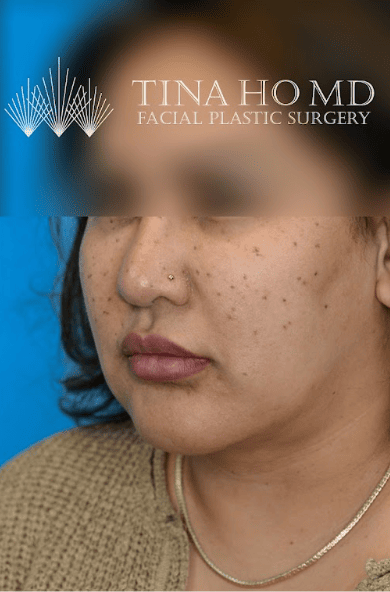 Patient's profile view after chin augmentation with improved definition