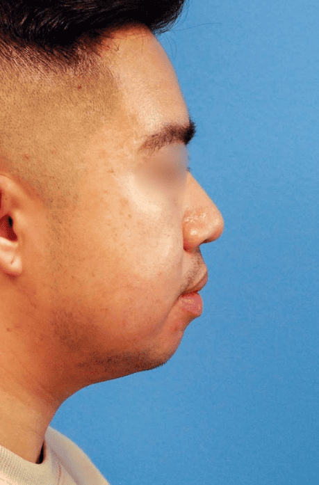 Side profile before submental liposuction and chin augmentation treatment