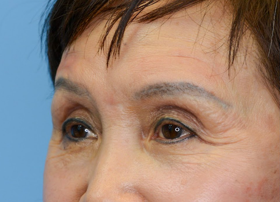 Patient's face before a Philadelphia brow lift