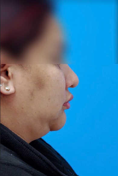 Patient's frontal view before chin augmentation to balance lower face