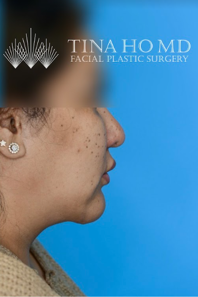 Patient's frontal view after chin augmentation showing balanced lower face