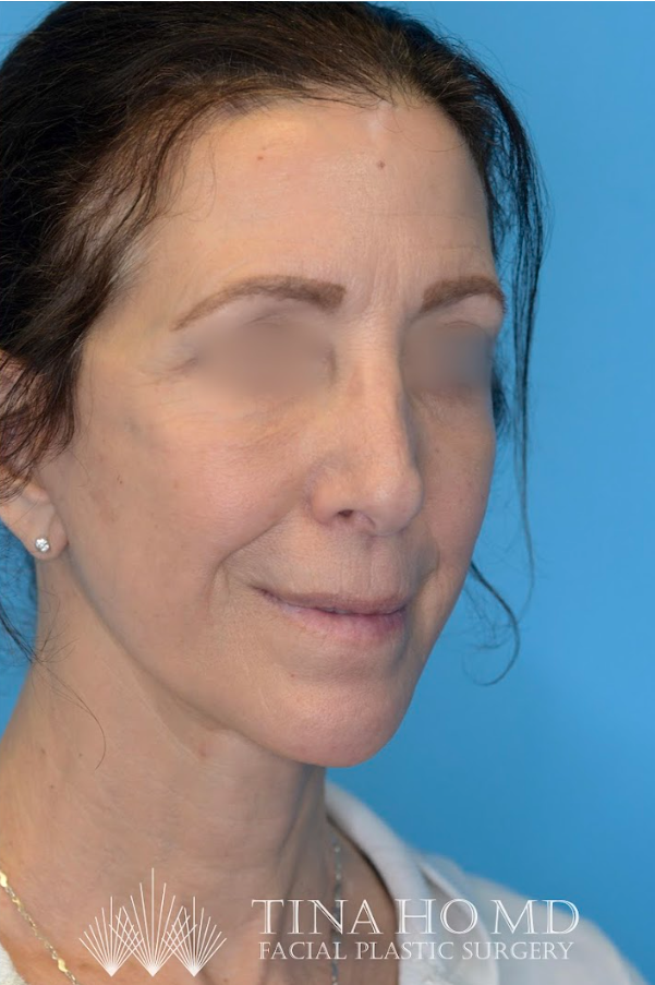 ML oblique after