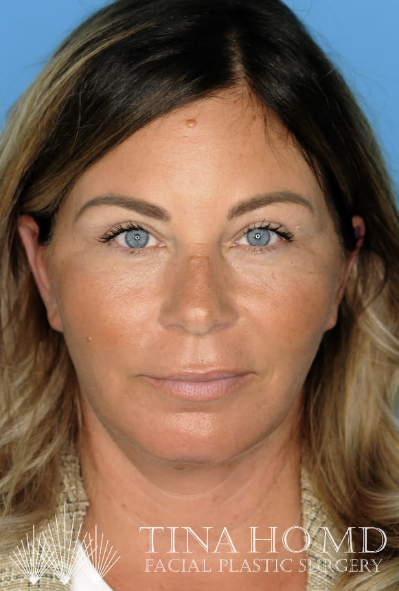 Patient's full face after chin augmentation with improved facial harmony