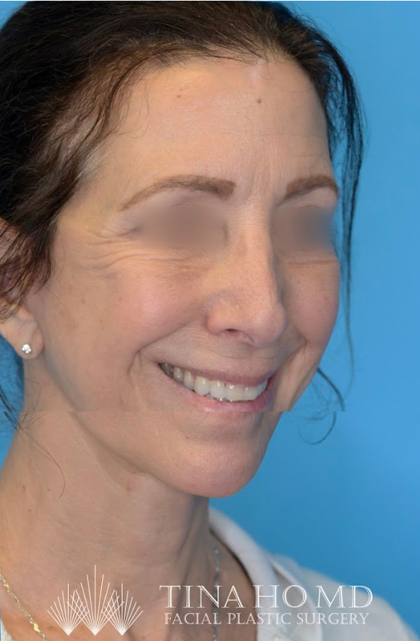 ML oblique after