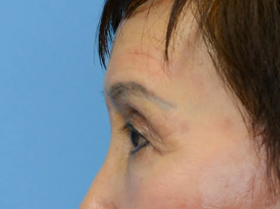 Patient's face before a Philadelphia brow lift