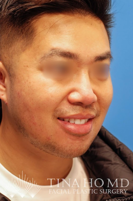 Man's firmer chin and neck after submental liposuction surgery