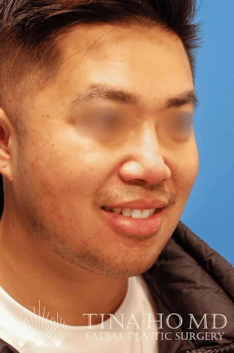 Patient's slightly angled frontal view after submental liposuction and chin augmentation