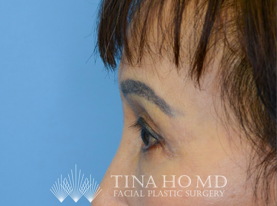 Patient's face after a Philadelphia brow lift