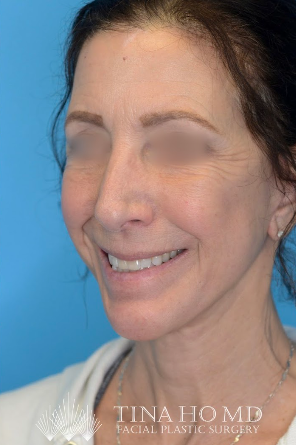 ML oblique after
