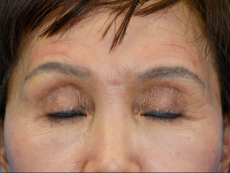 Patient's face before a Philadelphia brow lift