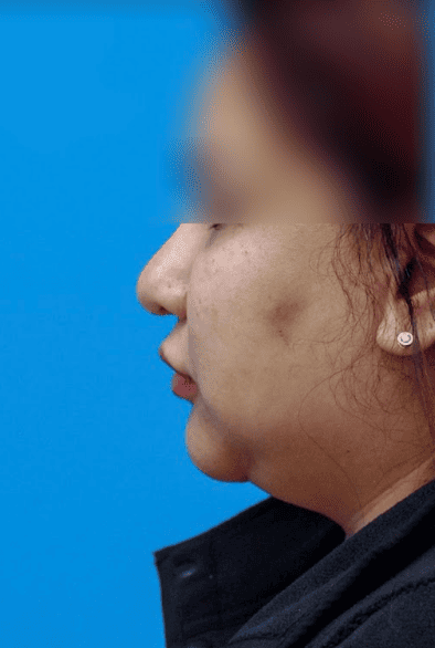 Patient's three-quarter view before chin augmentation for better facial contours