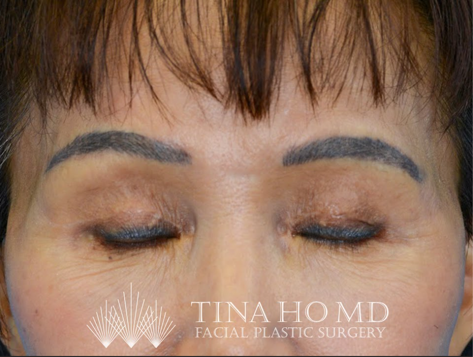 Patient's face after a Philadelphia brow lift