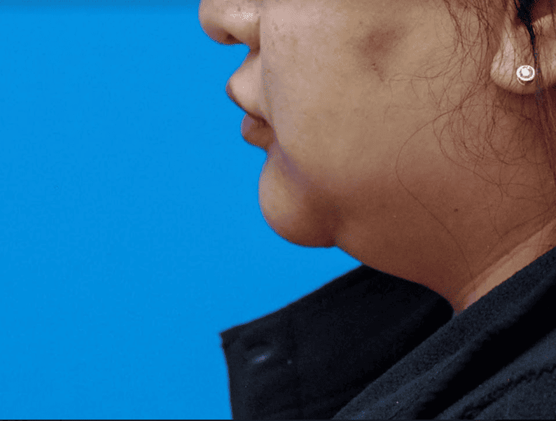 Patient's frontal view before chin augmentation to improve lower facial harmony