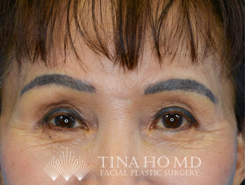 Patient's face after a Philadelphia brow lift