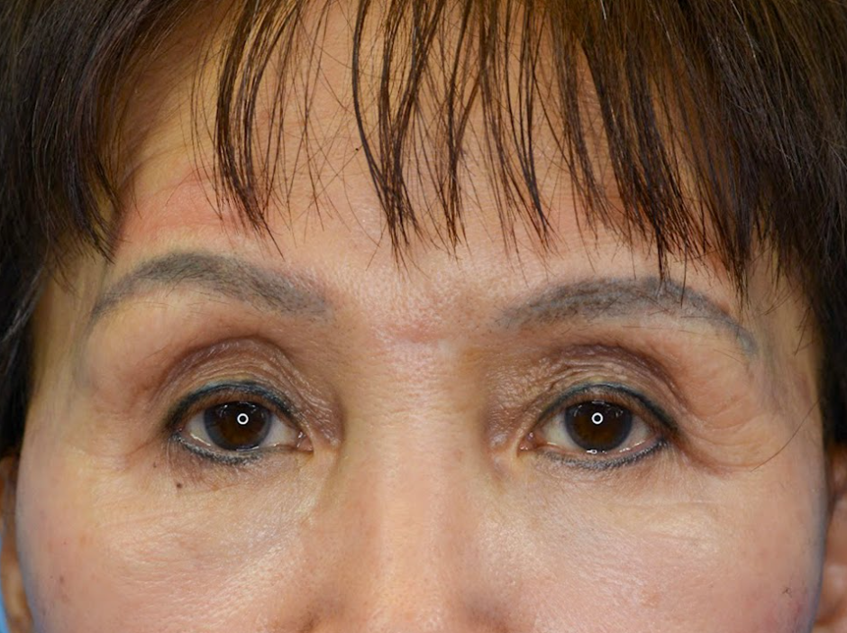 Patient's face before a Philadelphia brow lift