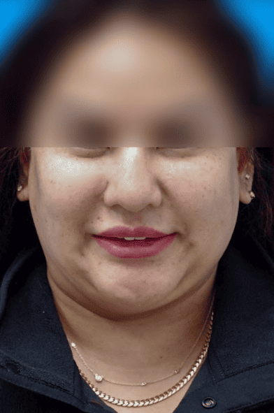 Patient's side profile before chin augmentation for a more defined jawline