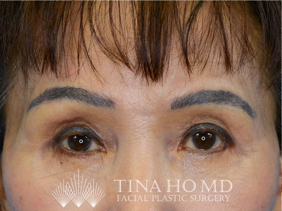 Patient's face after a Philadelphia brow lift