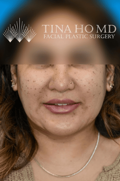 Patient's side profile after chin augmentation shows a more defined jawline