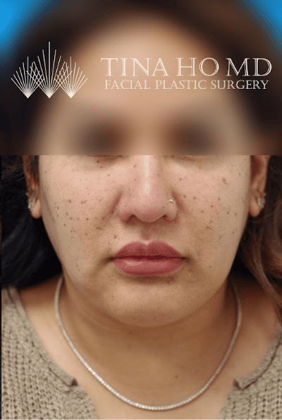 Patient's three-quarter profile after chin augmentation shows a balanced look