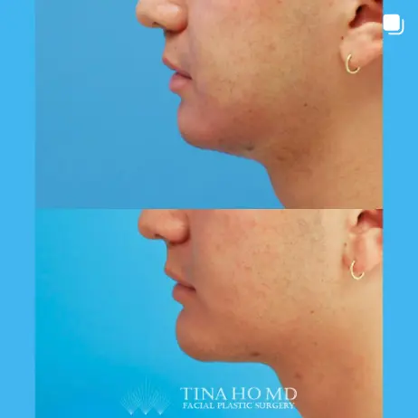 Facial_Contouring_IG_02