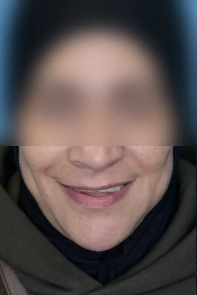 Frontal view of patient's lips before lip enhancement procedure