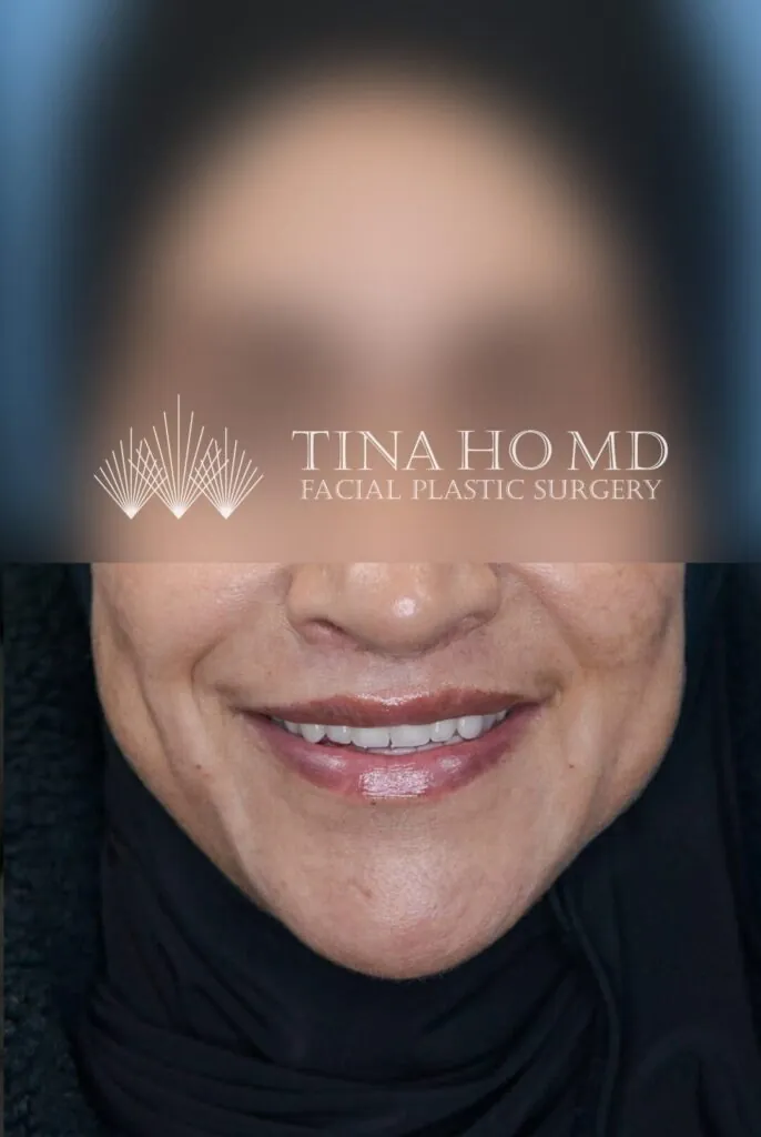 Frontal view of patient's lips after lip enhancement procedure