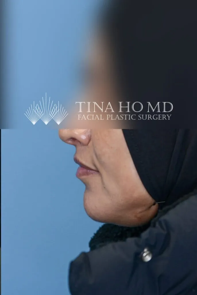 Left lateral view of patient's lips after lip enhancement