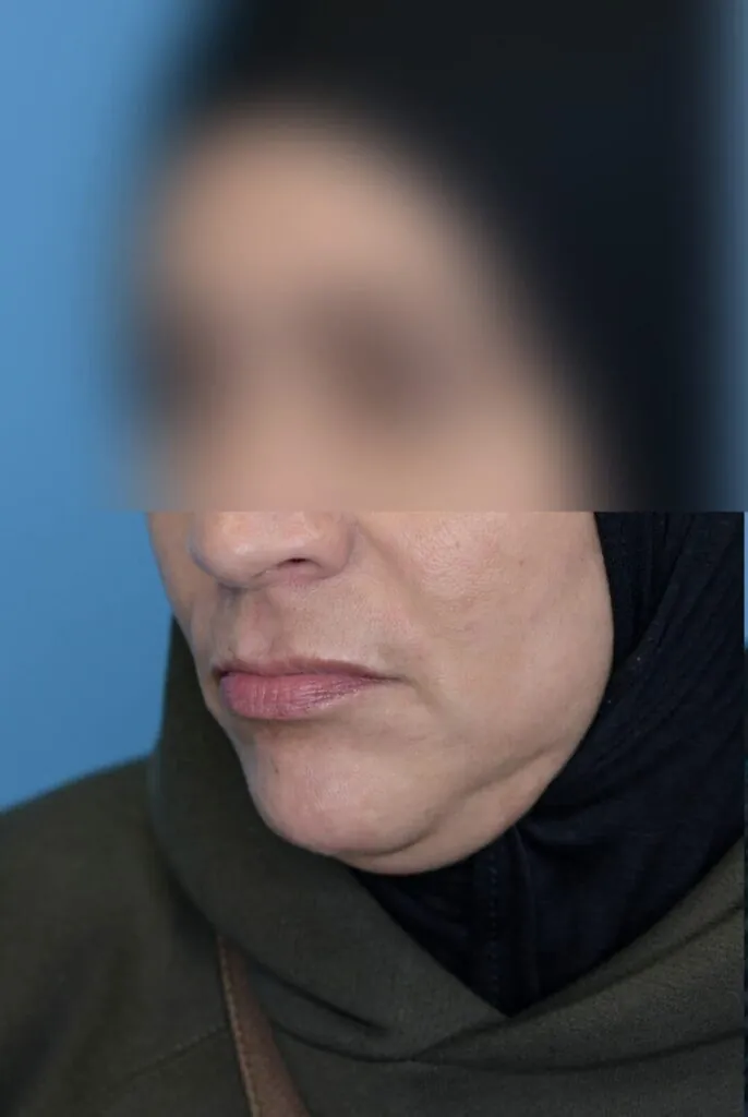 Left oblique view of patient's lips before lip augmentation