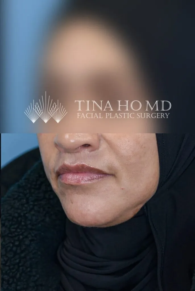Left oblique view of patient's lips after lip augmentation