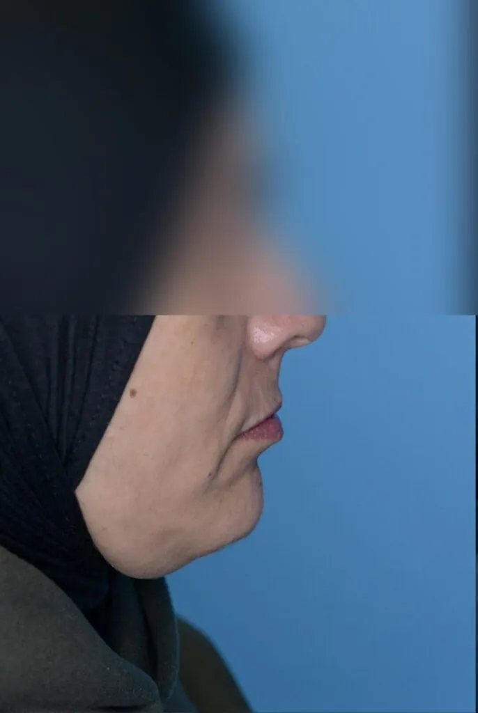 Right lateral view of patient's lips before lip surgery
