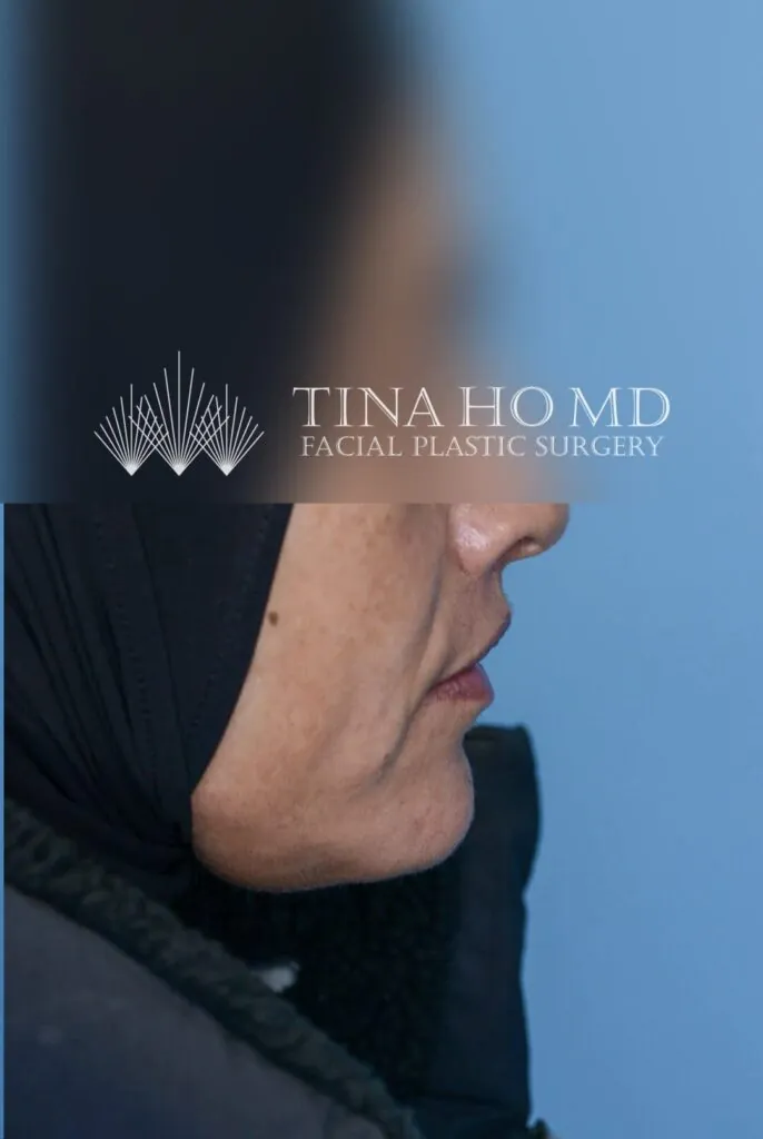 Right lateral view of patient's lips after lip surgery