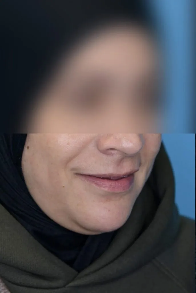 Right oblique view of patient's lips before lip augmentation